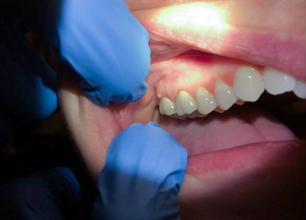 Best Emergency Dental Care for Abscessed Tooth in Palmer Lake, CO